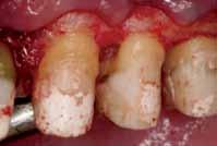 completion of treatment. Case report No. 2 As is often the case, caries control and provisionalization occurred prior to periodontal surgery (Fig. 21).