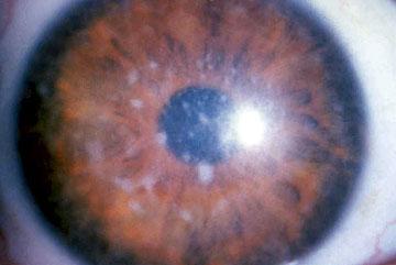 Macular (Groenouw Type II) Grayish opacities in the superficial stroma With age: extension into deeper