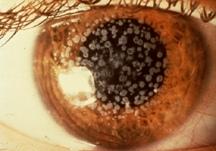 RCE are common with associated pain. Decreased vision results from subepithelial scarring or dense stromal deposits.