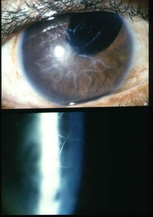 Lattice (Type I) The central cornea is progressively opacified resulting is scarring and deterioration of vision while