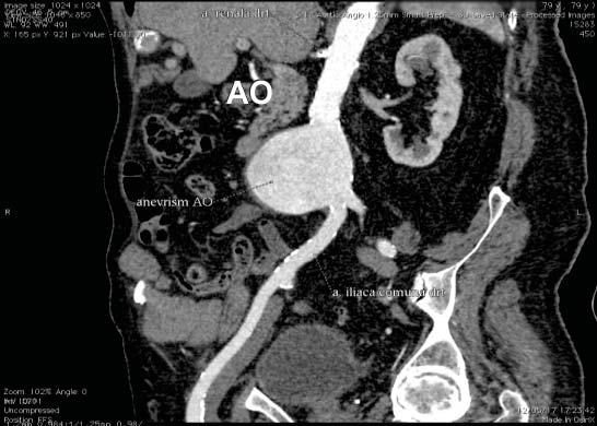 Romanian Journal of Cardiology Costica Baba et al. Figure 2. Measurements of the maximum diameters of the aortic aneurysm. AngioCT with contrast, sagital section. Figure 1.