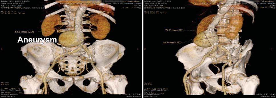 Both iliac and common femoral arteries were calcifi ed but normally sized with no signifi cant tortuosity (Figure 3).