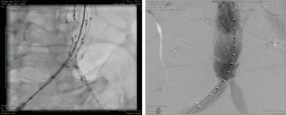 artery. Figure 5. Coronary angiography.