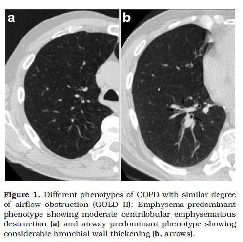 Heterogeneity of COPD Radiological phenotypes: