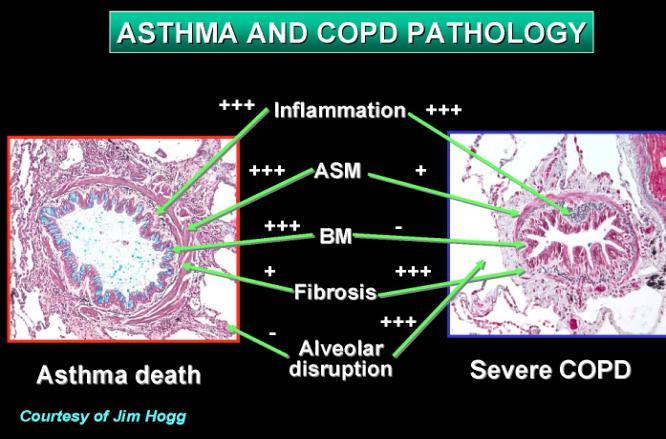 Differential Diagnosis: COPD and Asthma COPD Onset in mid-life Symptoms slowly progressive Long smoking history ASTHMA Onset early in life (often