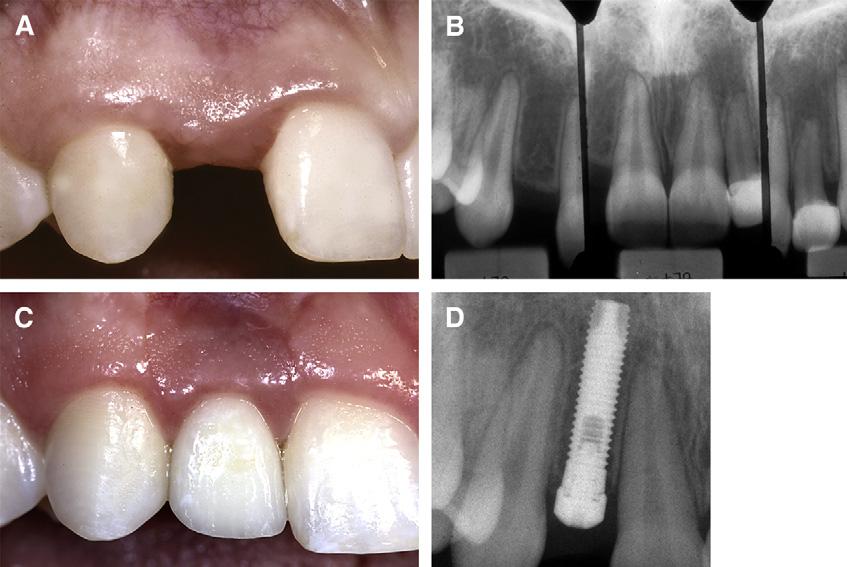 158.e2 Olsen and Kokich American Journal of Orthodontics and Dentofacial Orthopedics February 2010 Fig 1.