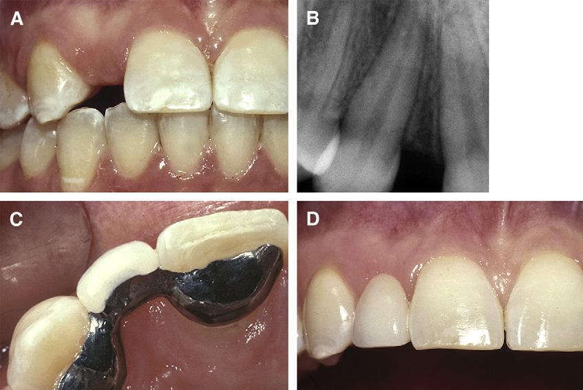 B, The anterior periapical radiographs of the implant site showed that the roots were far enough apart for C and D, implant placement and restoration of the missing tooth. Fig 2.