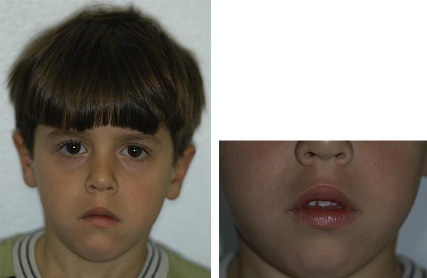 494 Bolan et al American Journal of Orthodontics and Dentofacial Orthopedics October 2010 Fig 1. Pretreatment photographs show the patient s high labial region and indistinct philtrum. Fig 2.