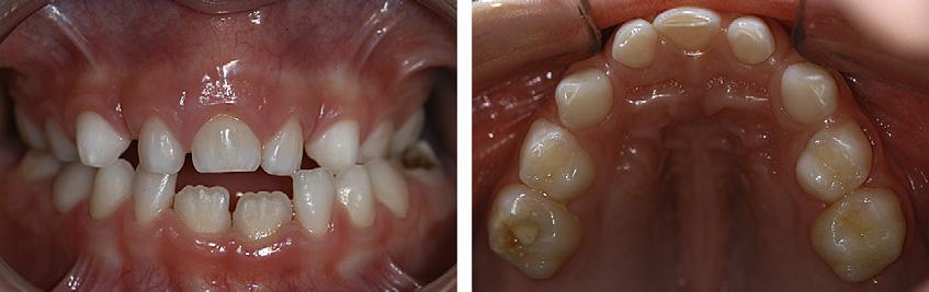 of tooth loss from trauma or extraction in the anterior region; this ruled out early loss of 1 incisor.