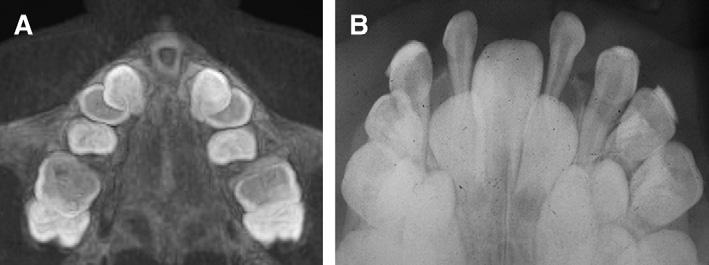 A, Axial CT slice and B, occlusal radiograph showing lack of intermaxillary suture opening. ordered by the otorhinolaryngologist showed that all structures were normal with no brain malformation.