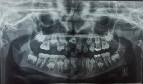 Shekarian, et al 67 Intra-oral examination revealed the following (Figure 1): The patient had Class I molar relationship, and the maxillary midline was found to shift to the right and the adjacent