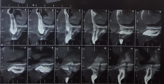 To understand the exact position of the tooth, occlusal radiograph and cone beam computed tomography (CBCT) scans were obtained, which showed the proximity of the tooth to the floor of the nasal