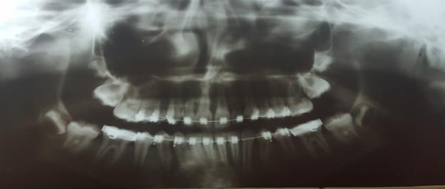 Treatment of a horizontally impacted central incisor 68 push coil was placed between the left central incisor and right lateral incisor to hinder these teeth from moving to the impacted central