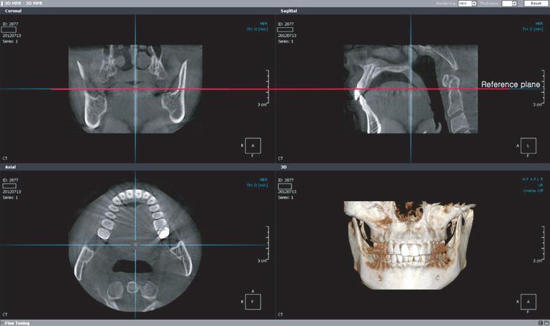 Choi et al 3D evaluation of a miniscrew implants Measurements The CBCT examinations were carried out after a vertical beam was fit to the central line of the patients faces in the natural head