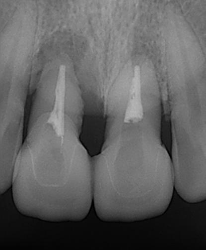 IMPLANTOLOGY In this study, crown restoration was carried out in connection with adjacent implant crown for the protection of relatively weak natural tooth, and a favorable prognosis was confirmed.