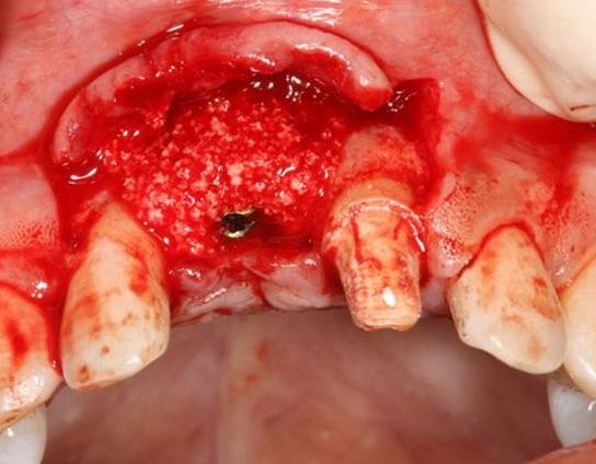 IMPLANTOLOGY Fig. 6. Bone graft after implant placement. mm 12.