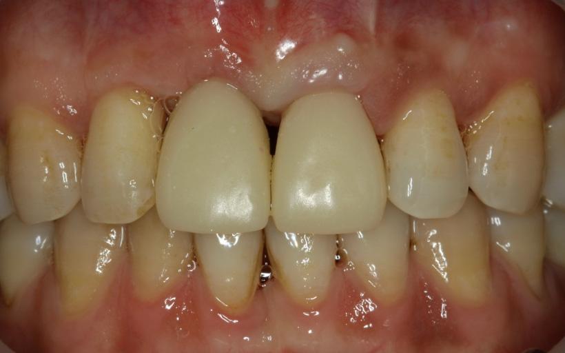 Fig. 9. Gingival shaping with provisional prosthesis. restoration.