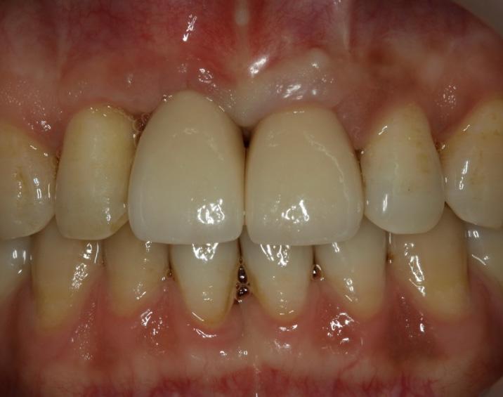 The root of the maxillary left central incisor being short and the prognosis being poor, so the crown was splinted with the maxillary right maxillary incisor implant prosthesis.