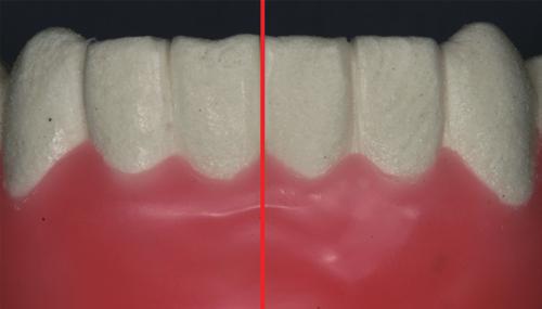Therefore, there have been trials for placing implants into extraction sockets with minimal flap elevation [15] or without the elevation of surgical flaps [16,17].
