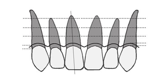 In addition, the depth of periodontal probe penetration was measured with a digital caliper (Absolute Digimatic, Mitutoyo Co., Tokyo, Japan) (Fig. 2B).