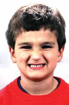 Sarver Figure 1: The patient first presented at age six with short lower facial height and
