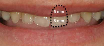 Surgical Treatment Planning The clinical measurements of upper lip to incisor relationships are essential to proper diagnosis.