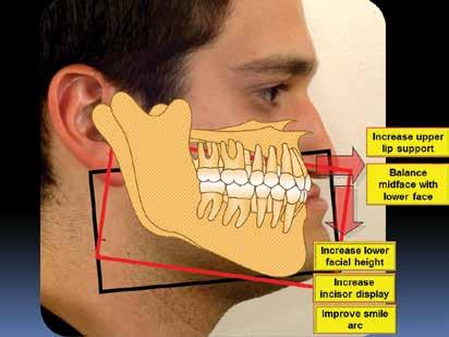 As the illustration indicates, the maxilla was planned to come forward to increase upper lip support and improve the soft tissue nasolabial folds.
