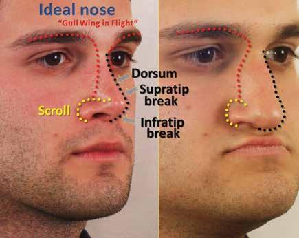 Also on this view, the low position of the nasal tip and the broad lateral nasal cartilages without a distinct scroll (the curvature from the base of the nose into the lateral nasal tip cartilages)