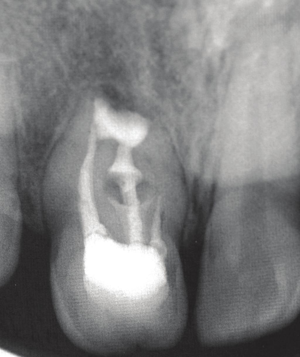 Retreatment of an invaginated maxillary central incisor performed during the 6-month follow-up showed incomplete bone