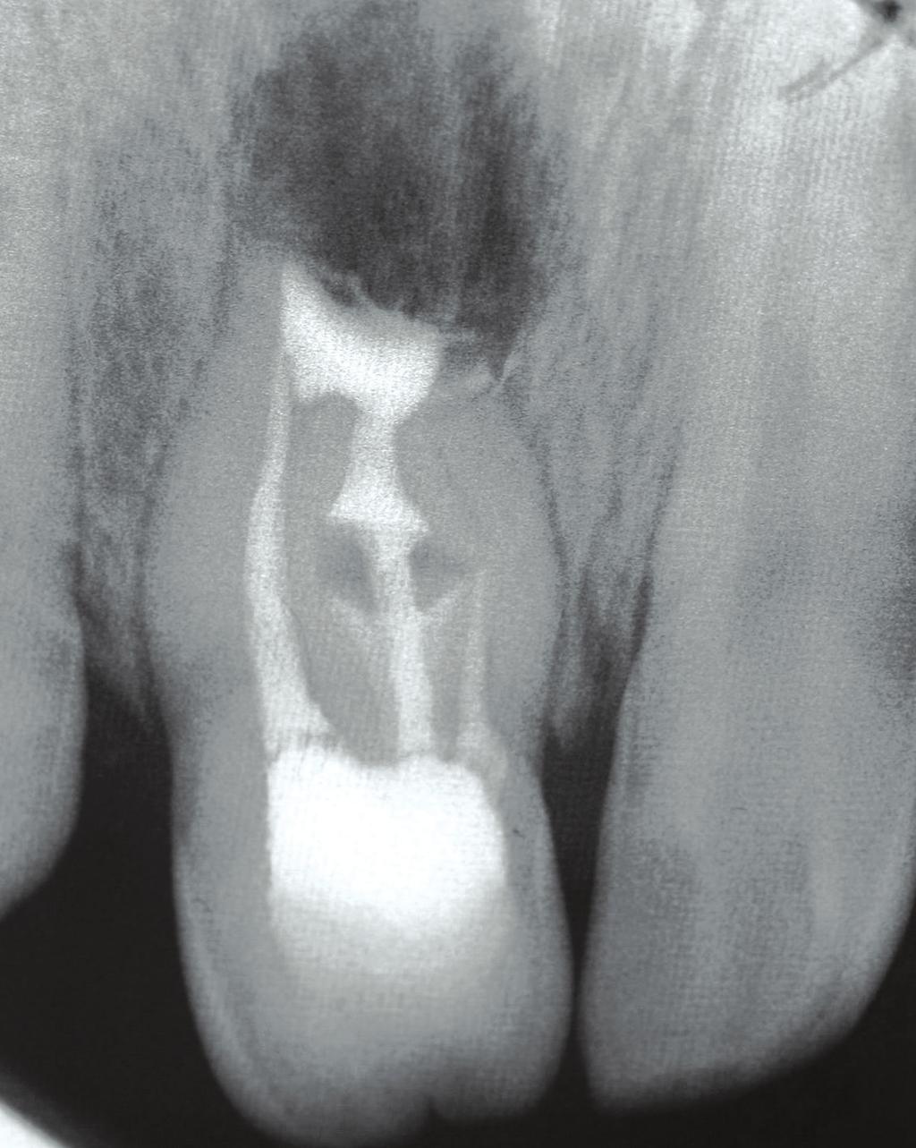 At the 2-year follow-up, the radiograph examination showed that the tooth exhibited no clinical symptoms, and there was