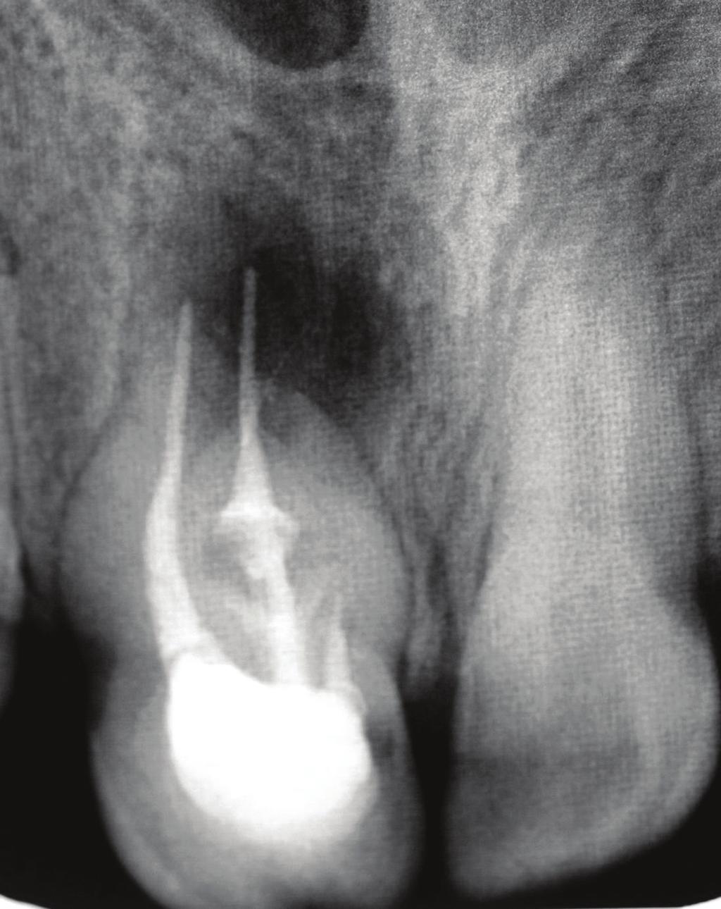 The periapical healing of the case was assessed according to the criteria used by Rud et al.8 Figure 1.