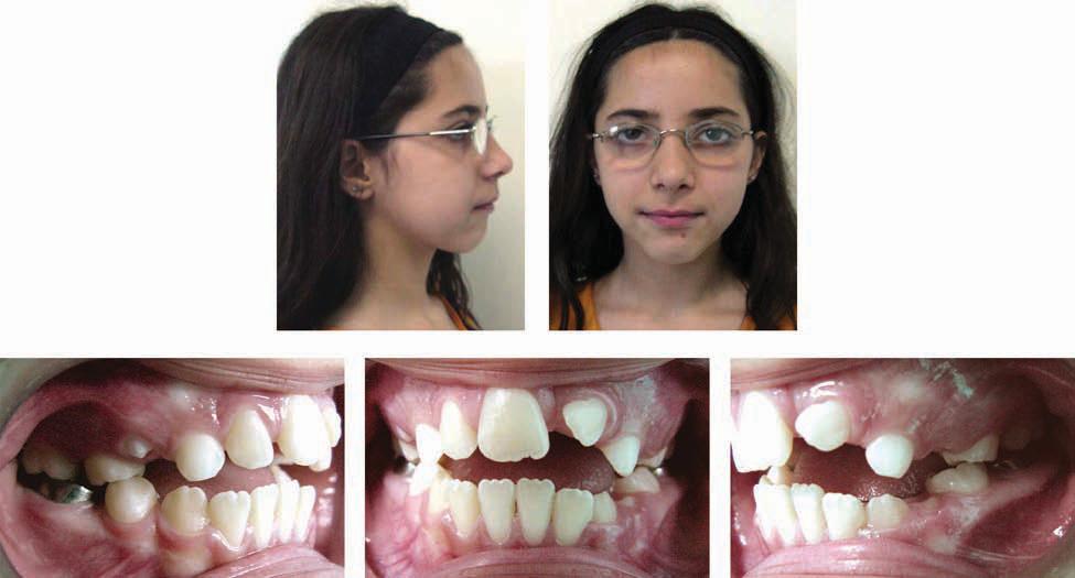 S134 Ruellas, Oliveira, and Pithon American Journal of Orthodontics and Dentofacial Orthopedics April 2009 Fig 1. Pretreatment photographs. Fig 2. Pretreatment dental models.