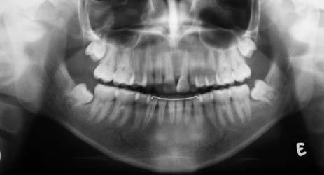 Esthetically and functionally, it is generally preferable to move the transposed teeth back to their normal positions in the maxillary arch.
