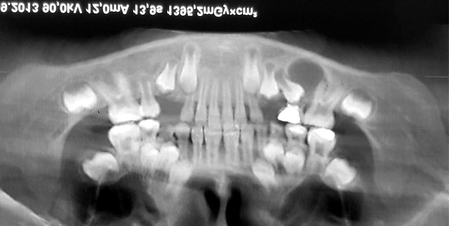 ) arious lesions were observed in the mandibular left second primary molar.