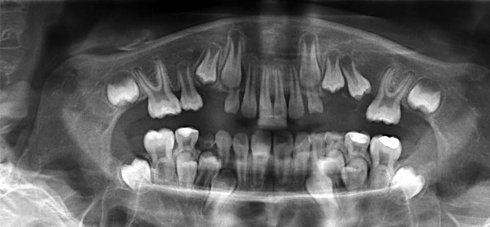 5 cm in diameter in proximity to the unerupted second premolar and displacing the tooth to the lower border of the mandible.(fig. 2.