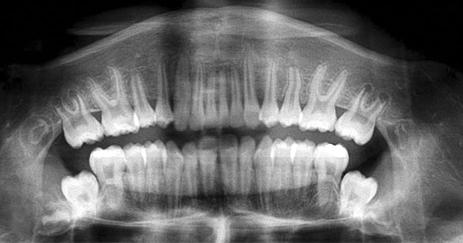 ) T imaging revealed a well-defined lesion in the mandibular left region surrounding the crown of the unerupted second premolar.