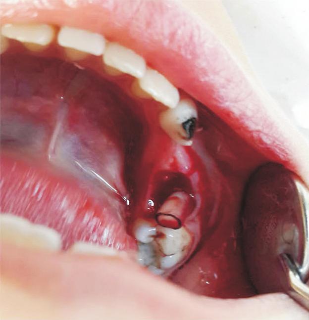 . Intraoral view showing buccal expansion in the region of the primary mandibular left second molar.