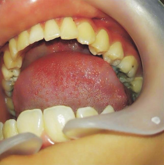 . Postoperative view of the second premolar, which erupted after 46 months.