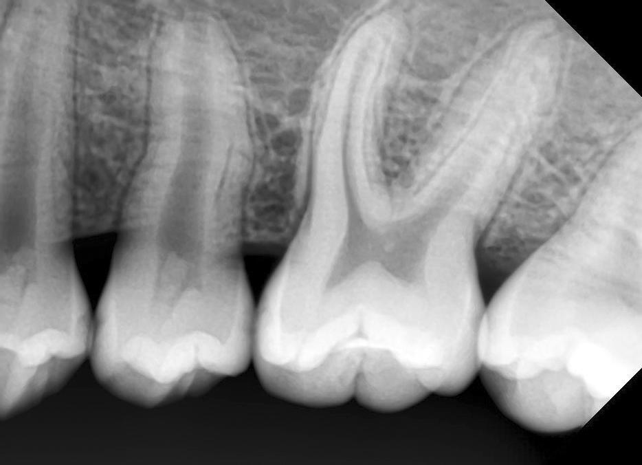 J Korean ssoc Oral Maxillofac Surg 2017;43 Suppl 1:S1-5 Fig. 5. Periapical radiograph of the second premolar at postoperative 46 months.