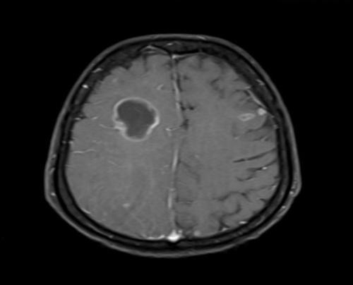 Among the extra axial neoplasm pituitary adenoma, meningioma, schawanoma have highest sensitivity and found to have 100%