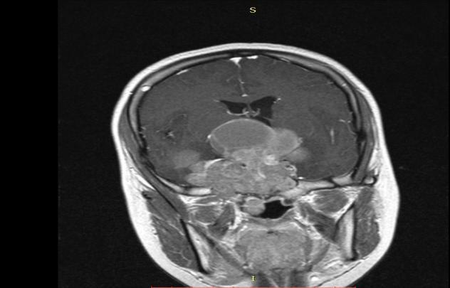 extra axial T2w isointense mass lesion with presence of CSF cleft -Meningioma Fig -6 T 1 W contrast