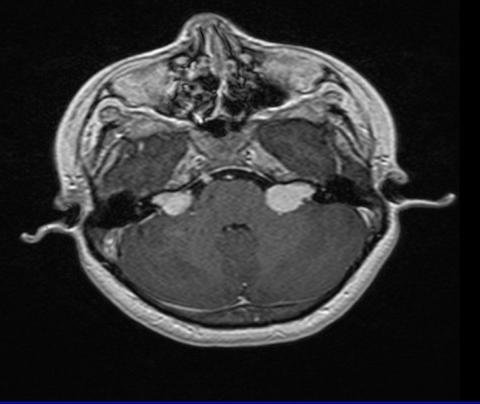 -7 T 1 W axial post contrast,t2w axial images showing hypointense lesions in B/L CP angles showing