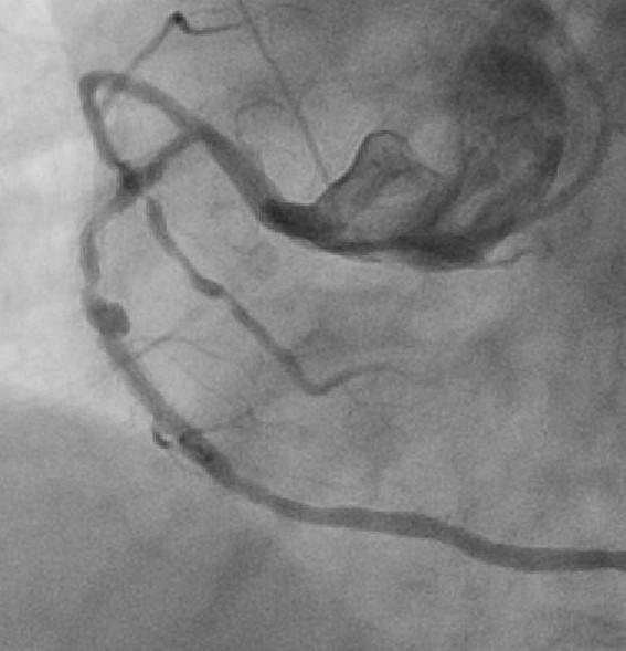 Incomplete Stent
