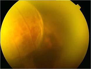 involving inferior retina, hyperemic peripaillary disk edema, macular exudates, defuse patchy intra retinal hemorrhagic areas and vascular sheathing.