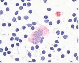 dijagnostičkog i prognostičkog profila limfoma na maloj količini stanica dobivenoj citološkom punkcijom (1).