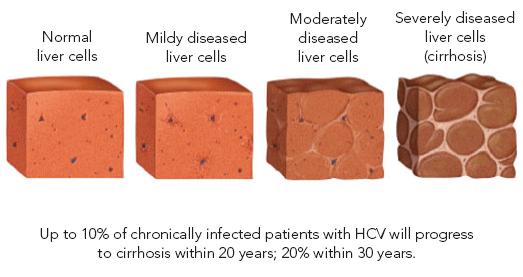Progression of Liver Disease Goal of HBV Treatment: prevention the development of