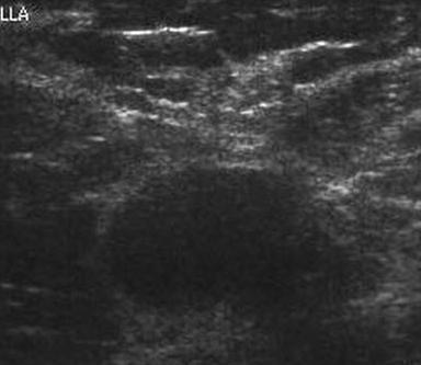 APPROACH: PATHOLOGY Ultrasound-guided FNAC Atypical or