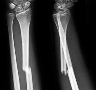 Management Peds Urgent Referral Open fractures Neurovascular compromise Displaced radius with intact ulna