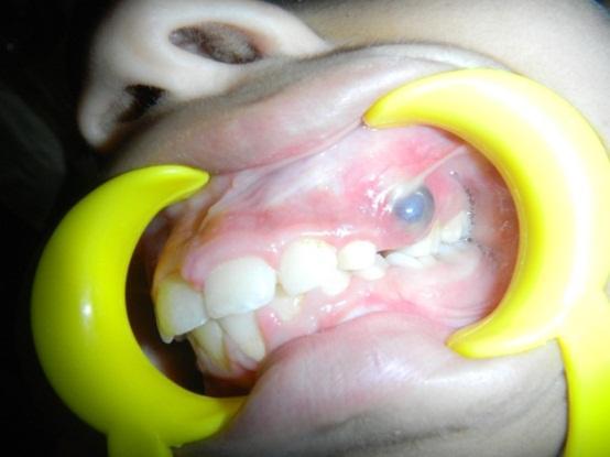 Fig. 1: Bluish brown dome shaped raised swelling in the region of maxillary left first premolar of 1x1cm size Fig.