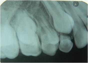 3: Surgical exposure was carried out to expose the erupting tooth In the present case it occurred on the left side.